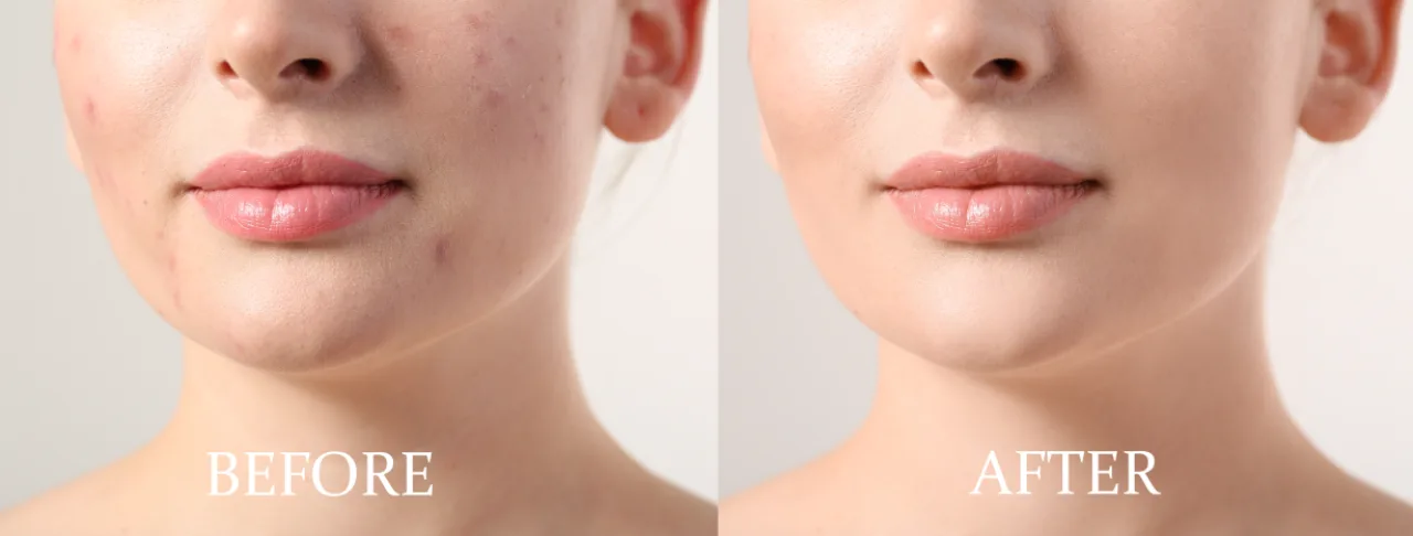 before and after acne treatment 